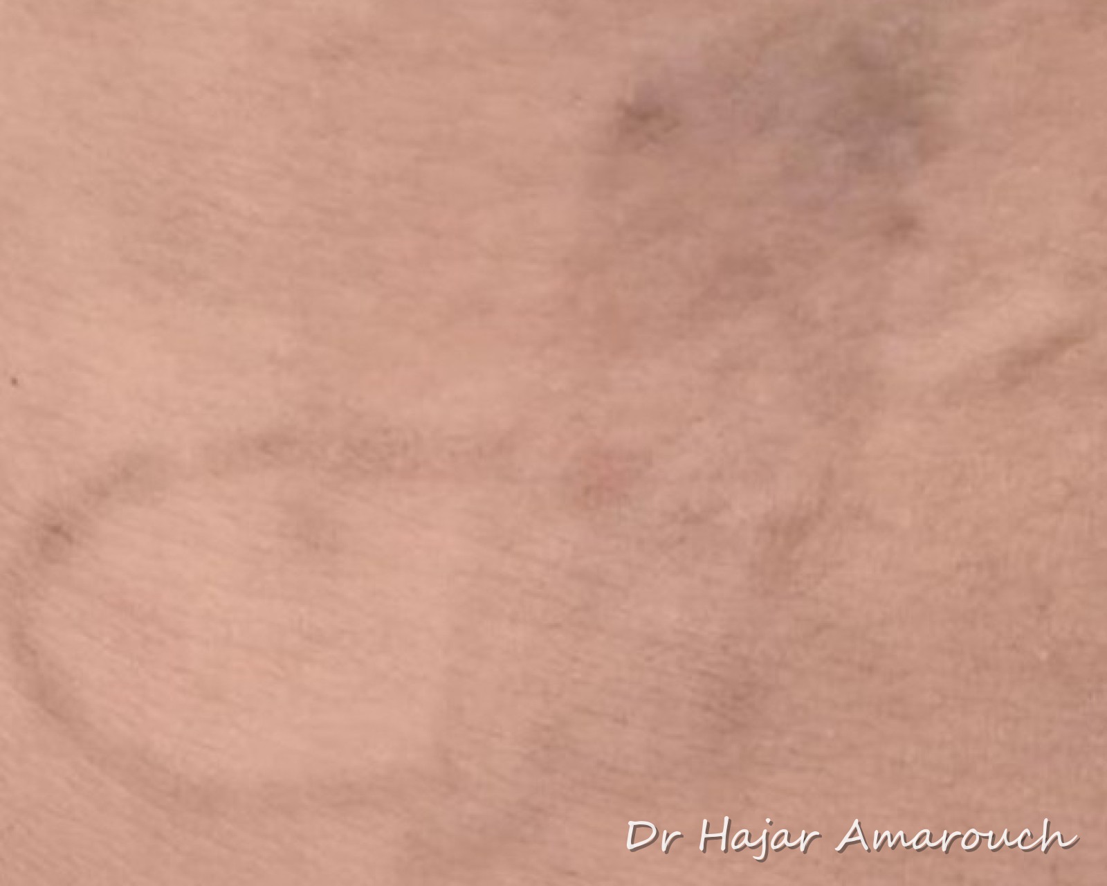 Après — Détatouage laser