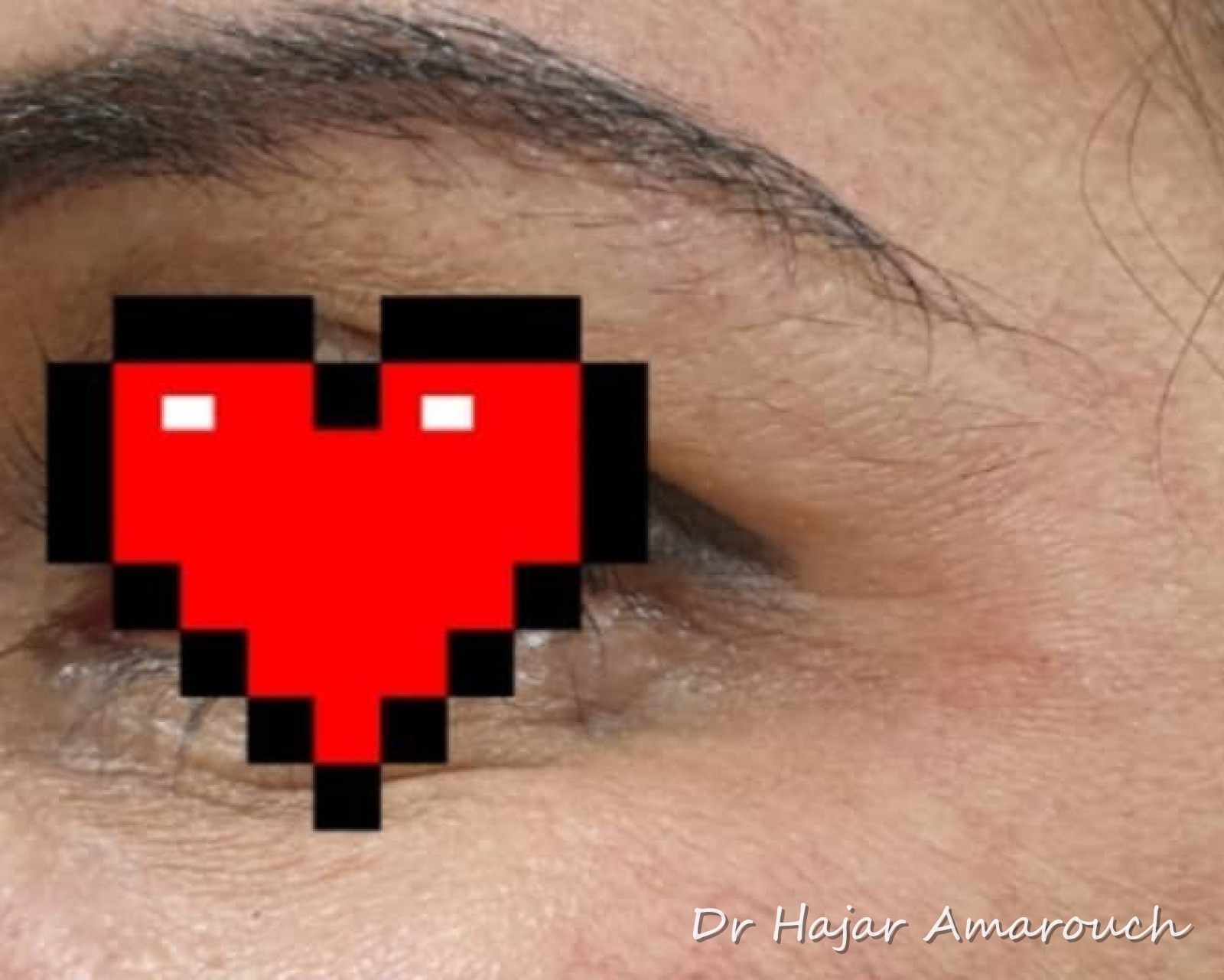 Après — Pattes d&rsquo;oie — Botox
