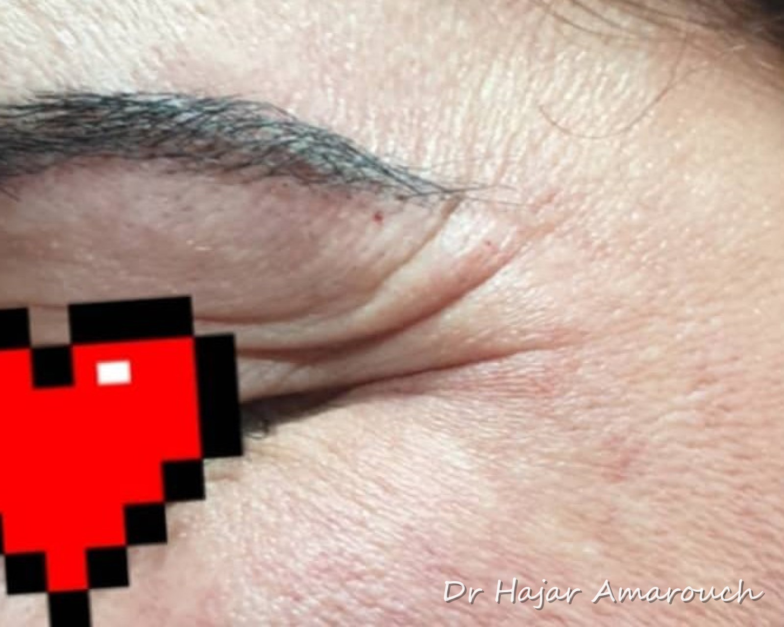 Avant — Pattes d&rsquo;oie — Botox