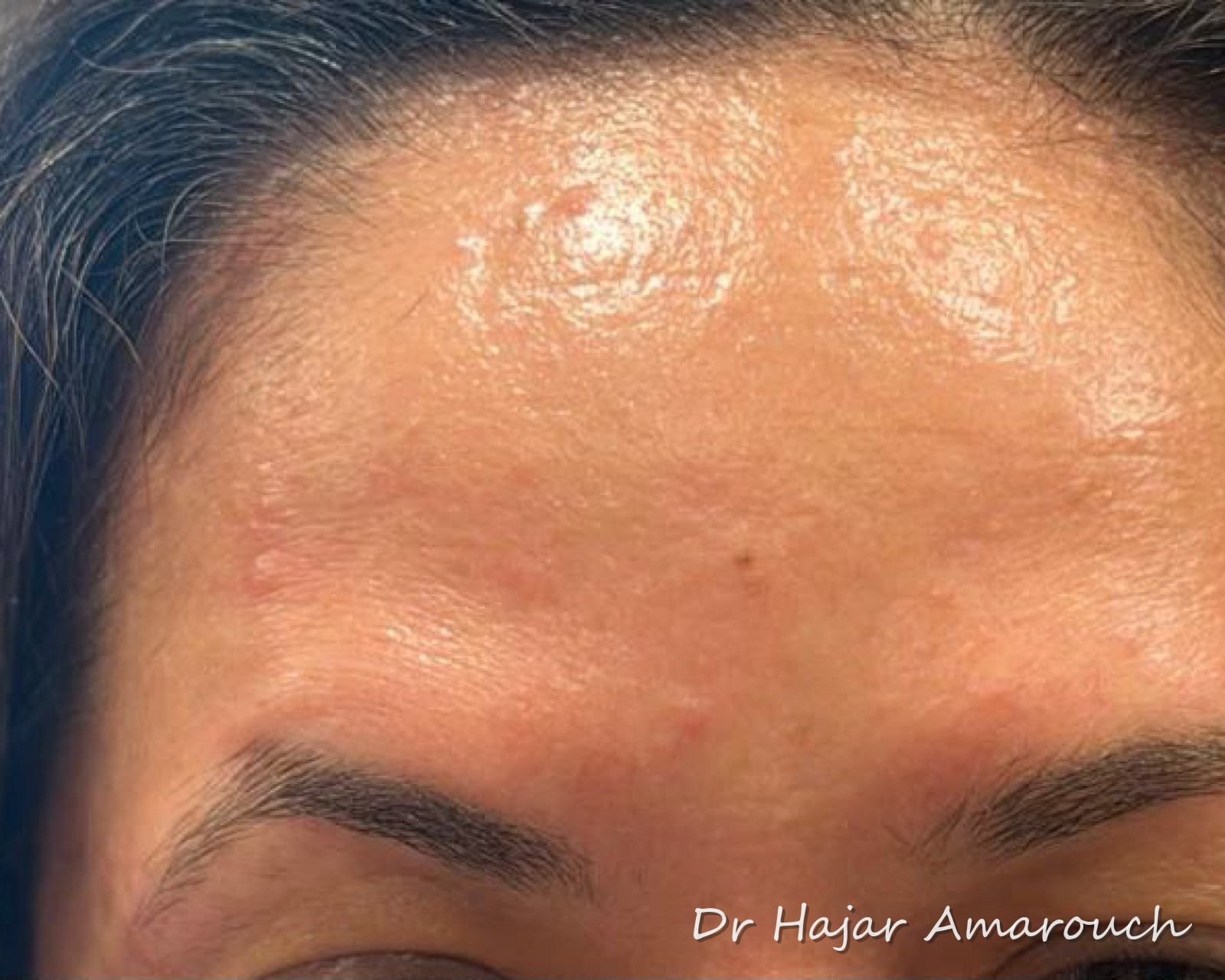 Après — Rides du front — Botox